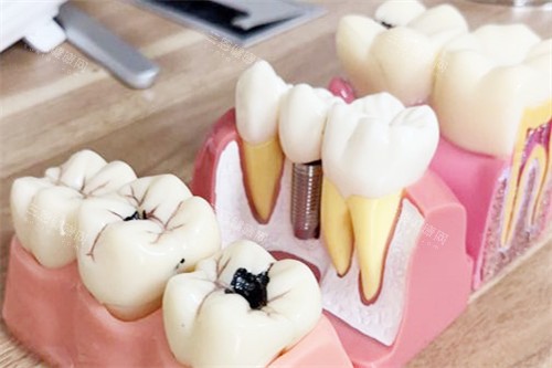 合肥靓美口腔医院种植牙模型 合肥靓美口腔医院种植牙模型