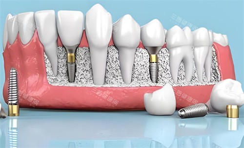 昌乐县2026牙科医院收费价目表：种植牙、矫正、综合治疗费用全解析