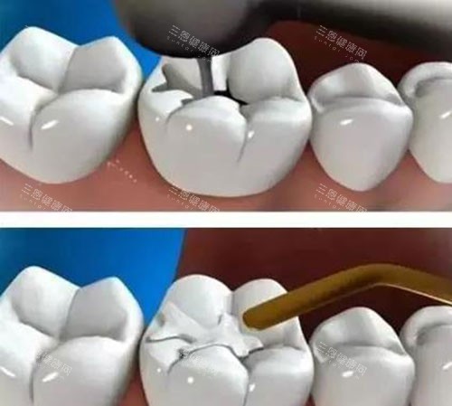 补牙过程示意图