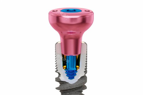 美奥口腔收费标准2026：种植牙2980元起，矫正5699元起