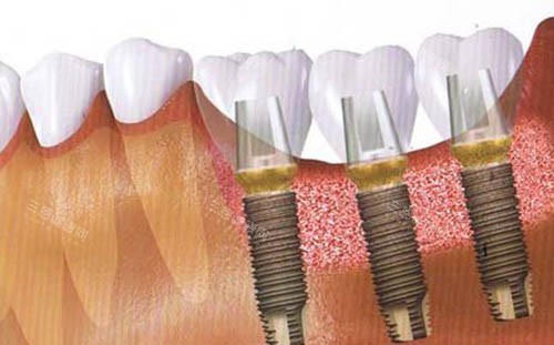 阳东爱牙口腔2025价格表查询，种牙5800起、牙齿矫正7800起、烤瓷牙1200起