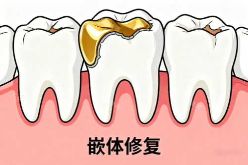 牙齿嵌体修复卡通图