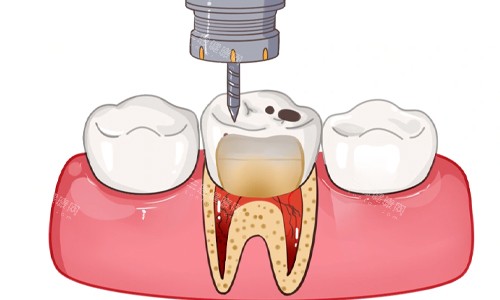 清除牙齿龋坏部分展示