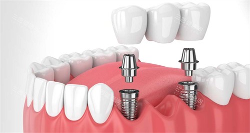 阳江看牙哪个医院好？爱牙&三仁&安喜&粤西及华联口腔整牙口碑好