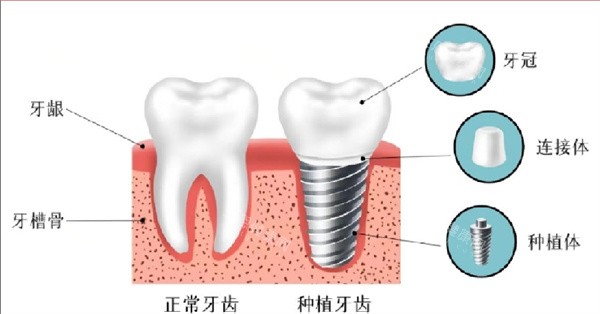 2025阳江看牙价目表查询，种牙|牙齿矫正|镶牙|补牙及牙冠费用一查