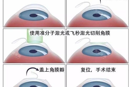 近视眼手术流程展示