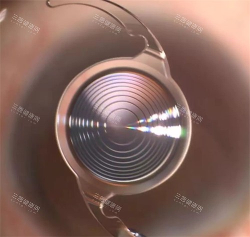 白内障竟晶体示意图