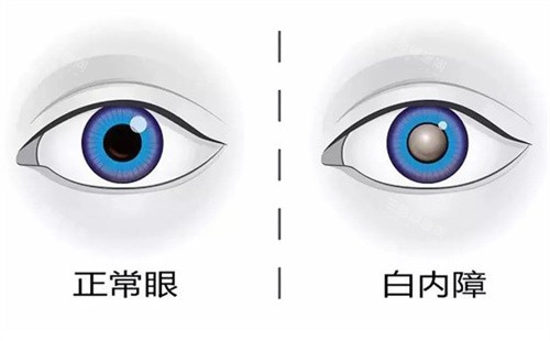 阳江白内障手术免费政策详解！2025年最新申请条件+流程，符合条件的千万别错过！