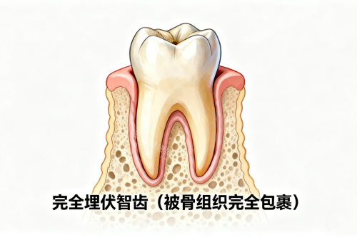 完全埋伏智齿展示图