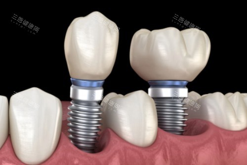 种植牙修复卡通一览