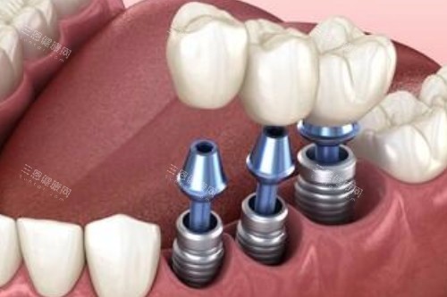 种植牙卡通图展示