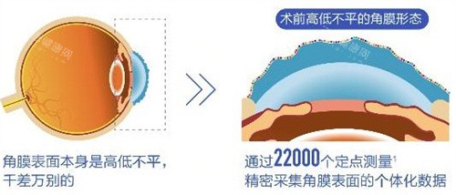 个性化飞秒术前