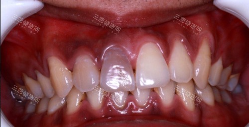 牙齿龋坏表现图