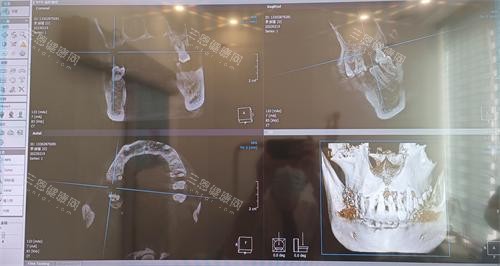 珠海仁爱口腔牙齿拍片