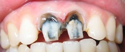 烤瓷牙前牙齿的情况