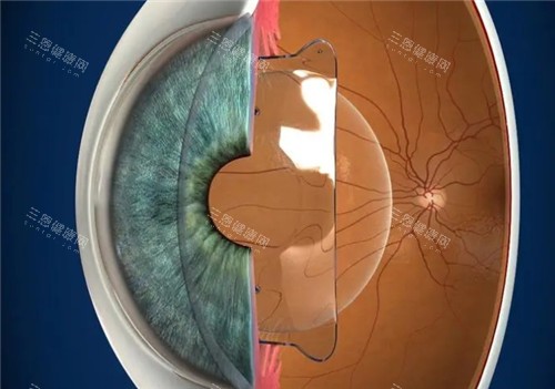 晶体植入近视手术模拟图