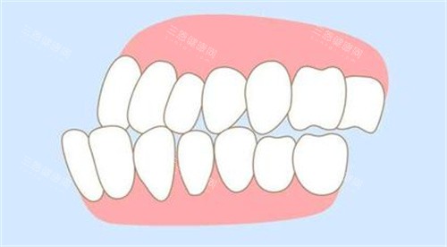 牙齿错颌畸形照片