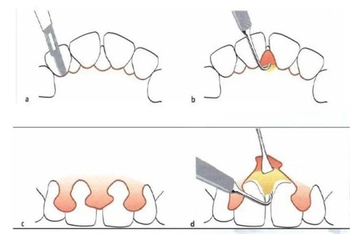 牙周炎翻瓣手术怎么做 牙周炎翻瓣手术怎么做