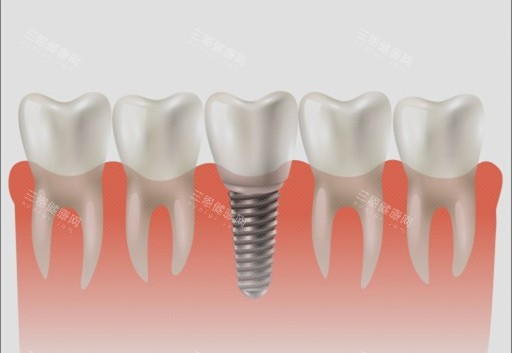 种植牙单颗漫画示意图 种植牙单颗漫画示意图