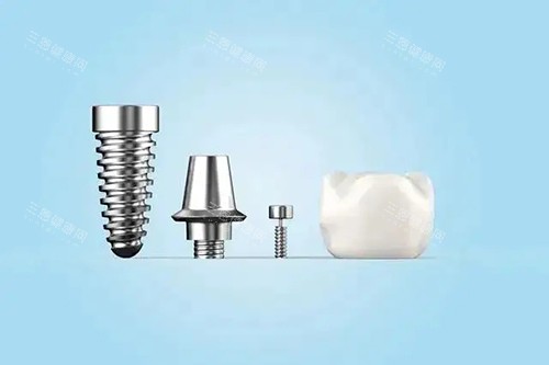种植牙不同部件模型示意图 种植牙不同部件模型示意图