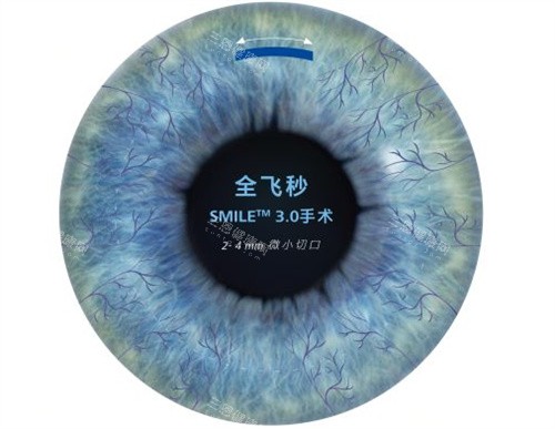 半飞秒手术卡通图