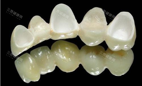 牙冠全瓷牙材料示意图