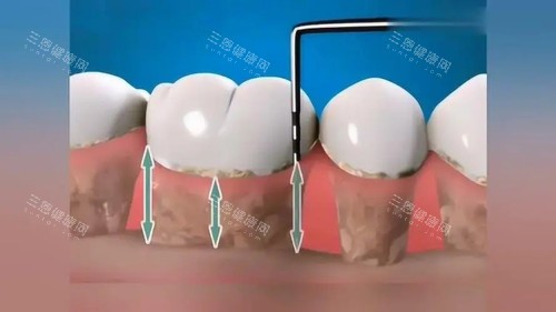 牙周刮治漫画图