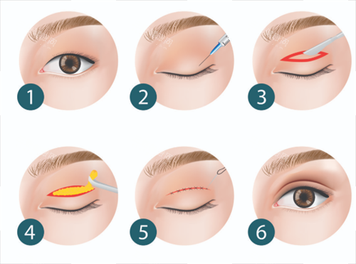 谭敏峰眼修复技术优势解析：深层次组织复位与审美设计，高难度实例！