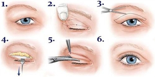 双眼皮全切术过程图