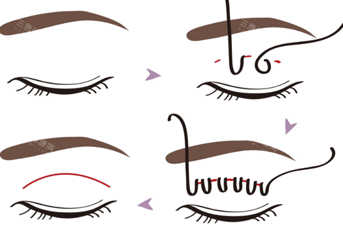 埋线双眼皮手术步骤图 埋线双眼皮手术步骤图