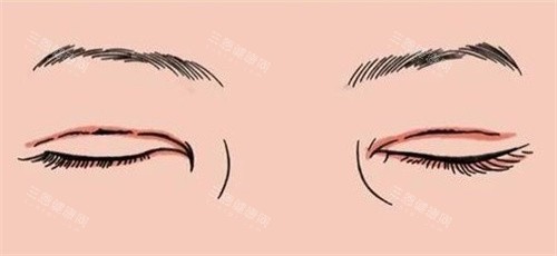 双眼皮疤痕修复 双眼皮疤痕修复