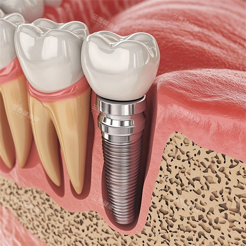 上海永华口腔怎么样？口碑实打实！种植体选品良心，术后复查及时，街坊邻居都认准它！