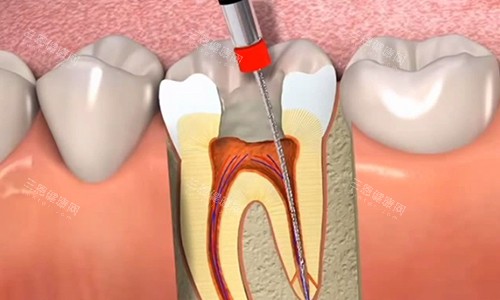 根管治疗中的过程 根管治疗中的过程
