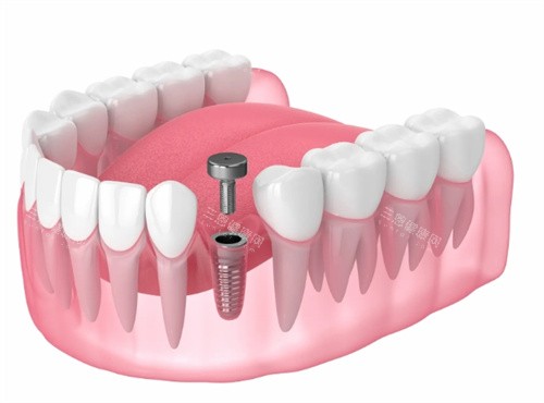 鞍山德立联合口腔医院2026年价目表，种牙|牙齿矫正|镶牙|补牙|根管治疗费用