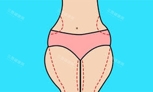 大腿吸脂手术设计方案示意图 大腿吸脂手术设计方案示意图