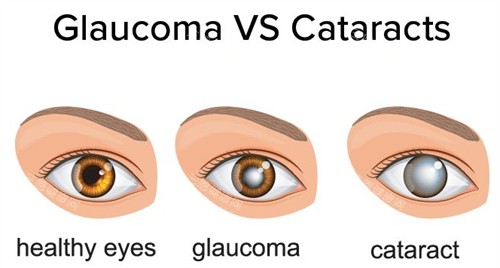 正常眼睛白内障和青光眼 正常眼睛白内障和青光眼