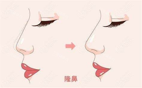 隆鼻术图 隆鼻术图