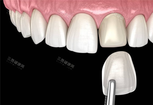 单颗牙齿贴面图