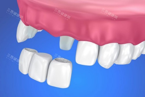 镶牙具体安装图