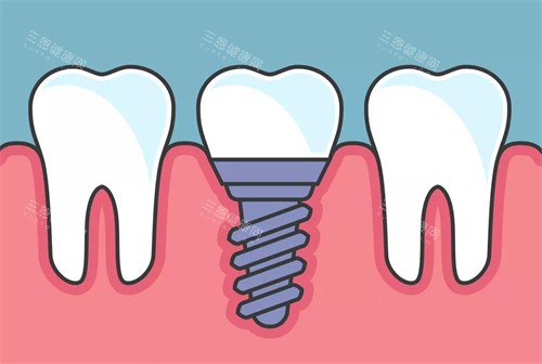 种植牙植入后漫画示意图