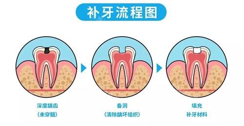 补牙的流程