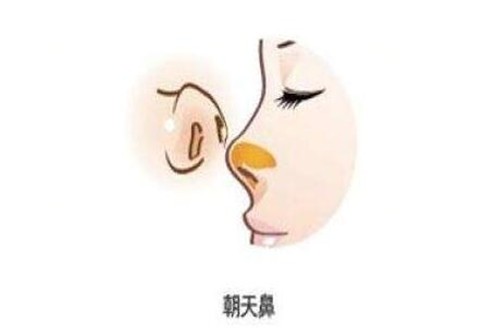 朝天鼻整形手术