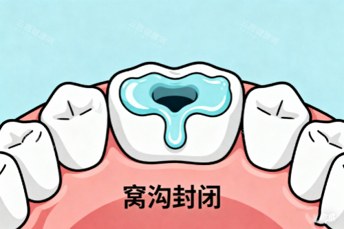 牙齿窝沟封闭展示图