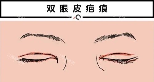 双眼皮疤痕修复动画图
