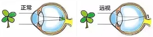 正常眼睛成像和远视眼睛成像 正常眼睛成像和远视眼睛成像
