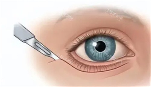眼周筋膜提升切口