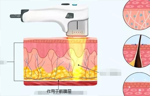 超声治疗作用于筋膜层动画展示