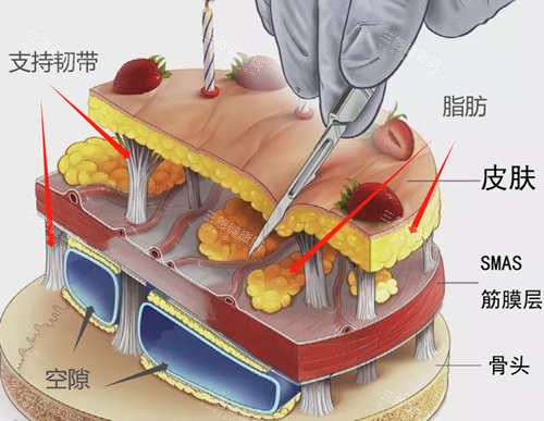 SMAS筋膜层