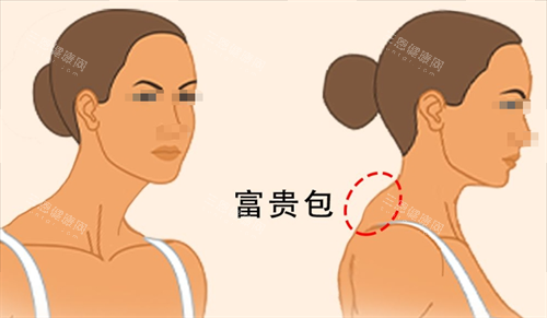 富贵包侧面展示图