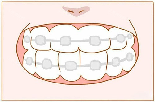 牙齿矫正漫画展示图 牙齿矫正漫画展示图